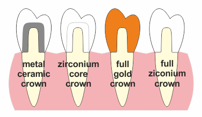 Types of dental crowns